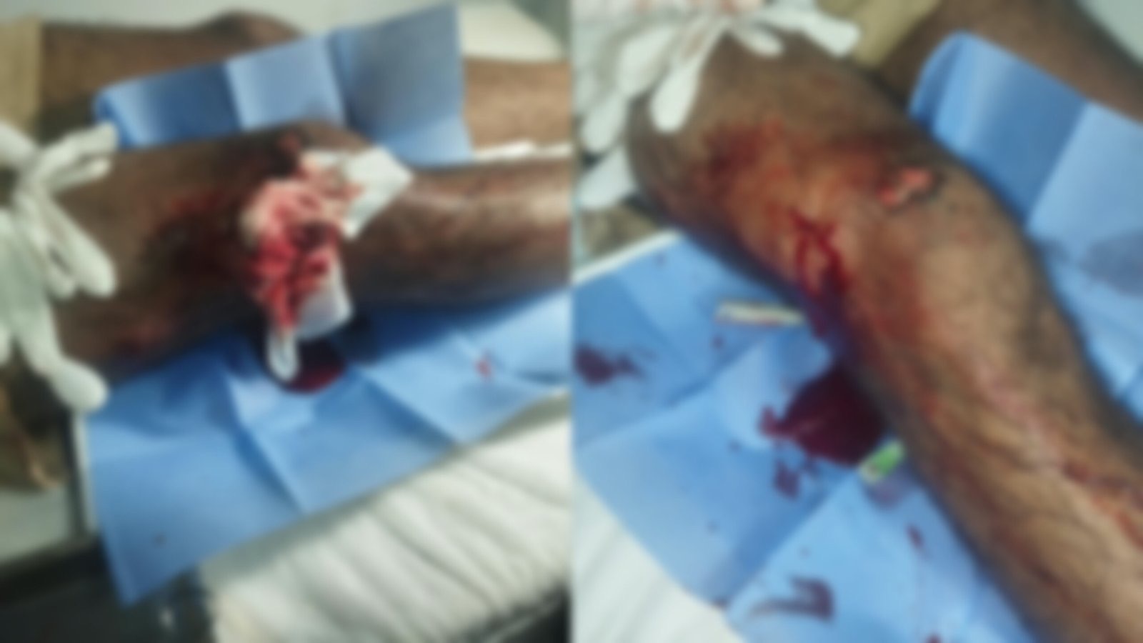 Jovem é baleado na perna em ramal da comunidade Cuiú-Cuiú, região de Itaituba